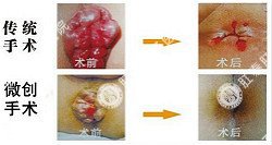 治痔疮怕痛？创口微小手术帮助您